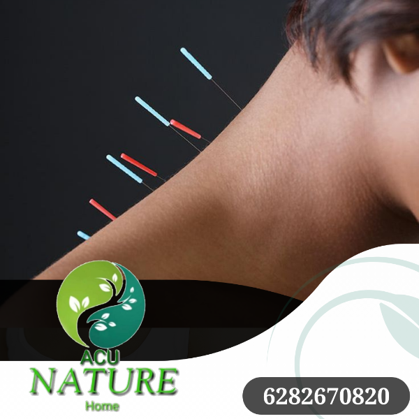 Acupuncture Therapy