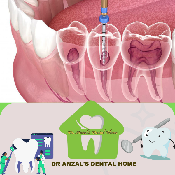 Root canal treatment