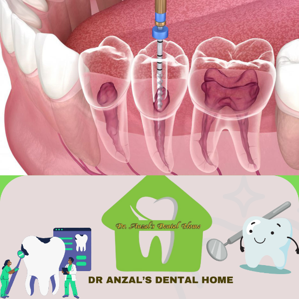 Root canal treatment
