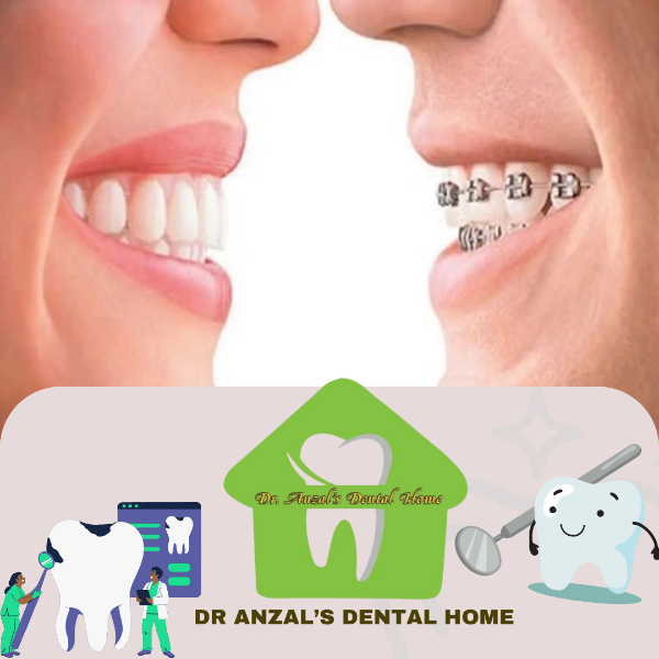 Orthodontic treatment- steel & ceramic braces,clear aligner
