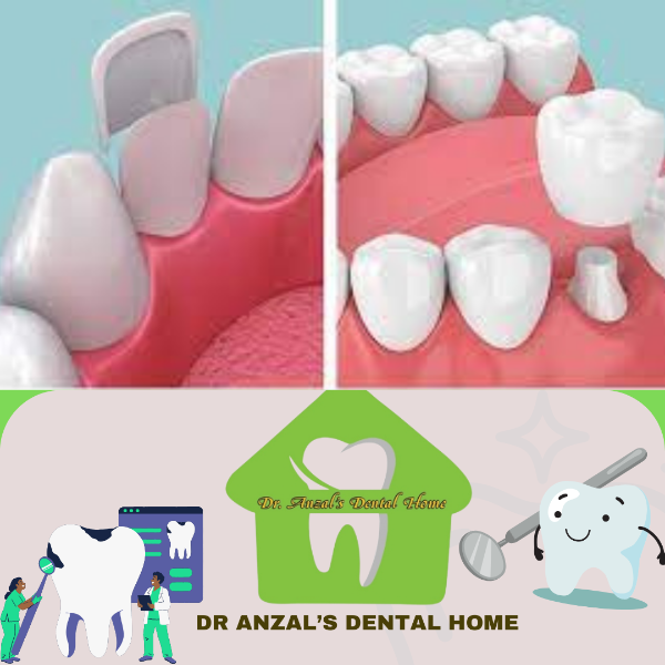 Veneers and Crown