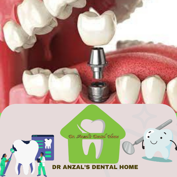 Dental implants
