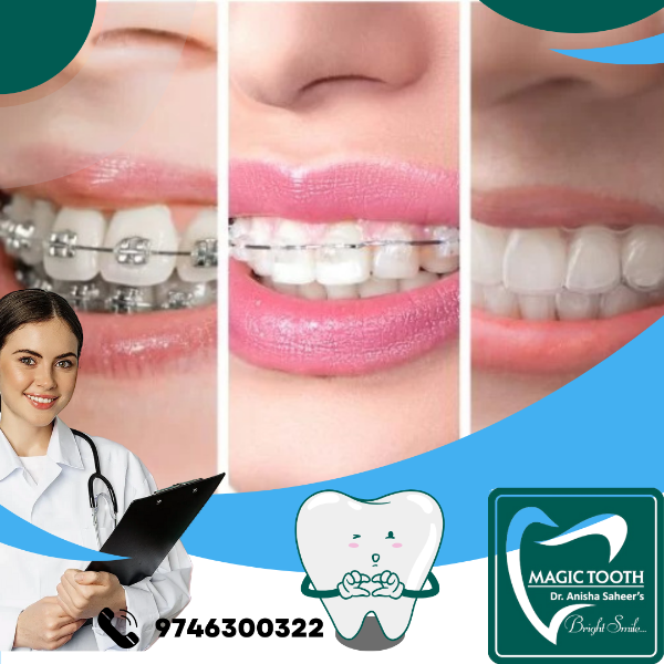Aligners