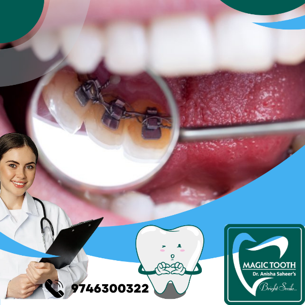 Lingual Braces