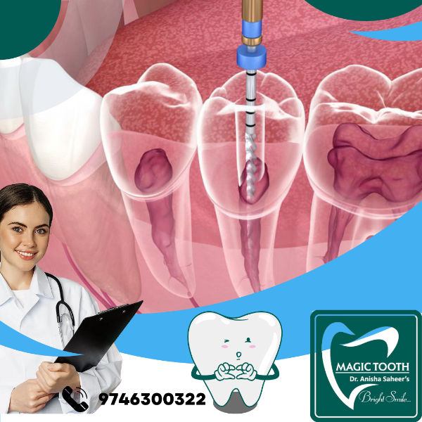 Single Sitting Root Canal Treatment