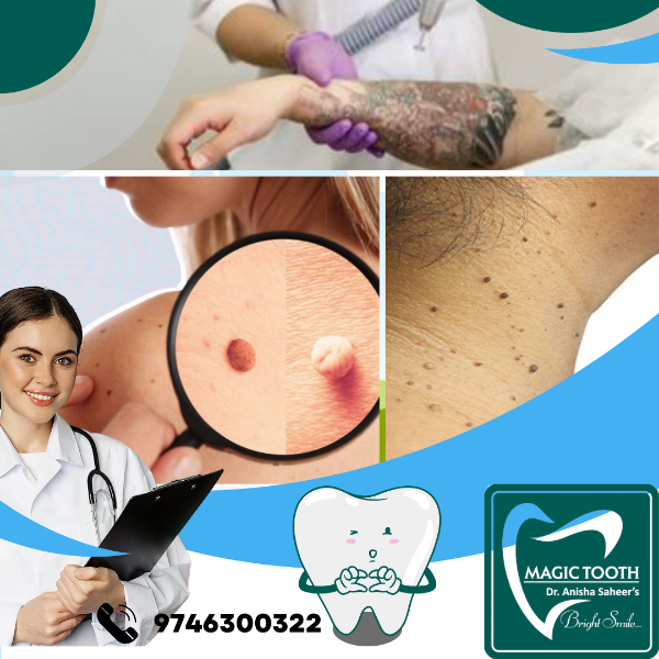 Painless removal of warts, skin tag, moles, tattoo