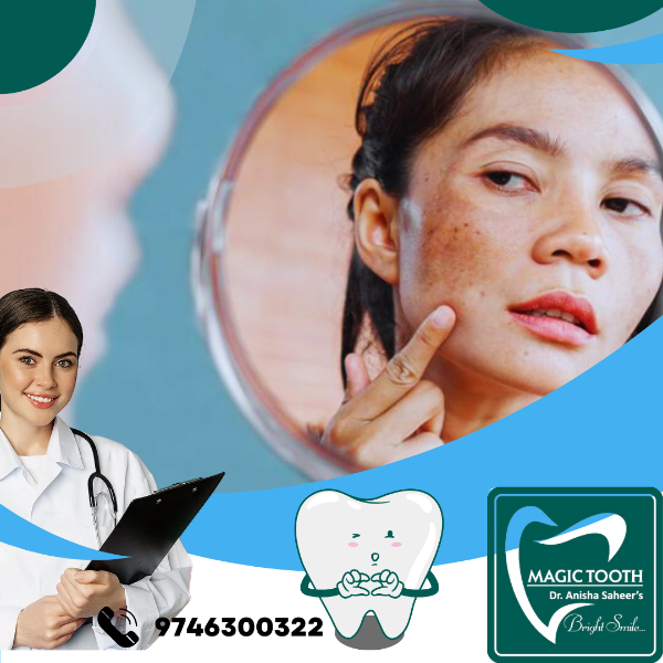 Hyper pigmentation Treatment