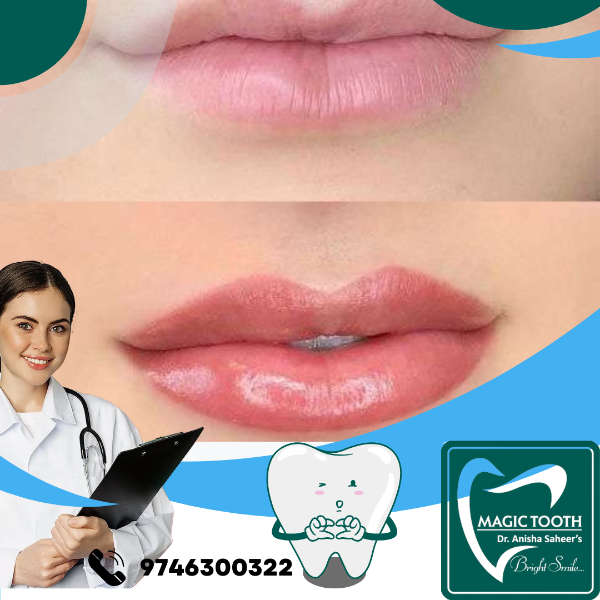 Lip Pigmentation