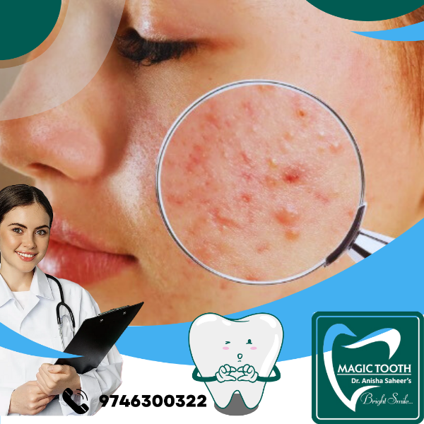Acne treatment