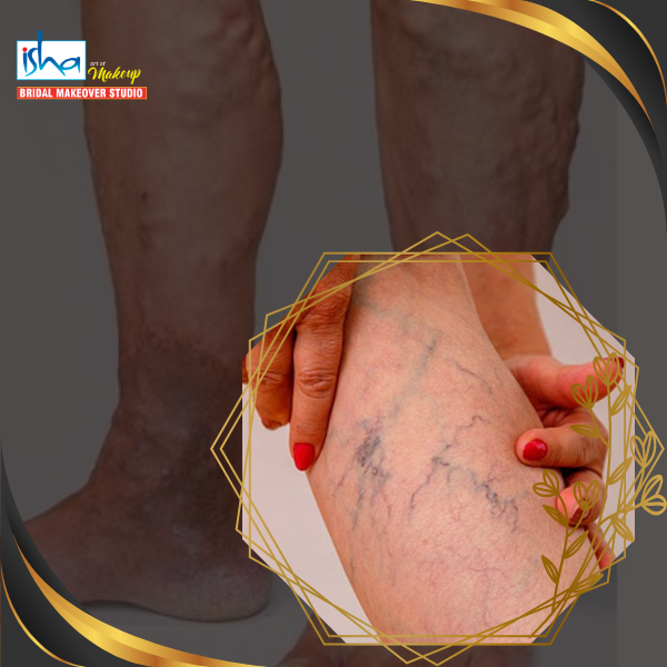 VARICOSE VEIN TREATMENT