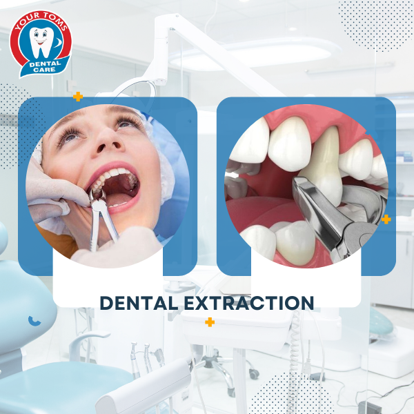 DENTAL EXTRACTION