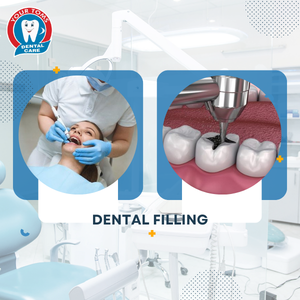 DENTAL FILLING