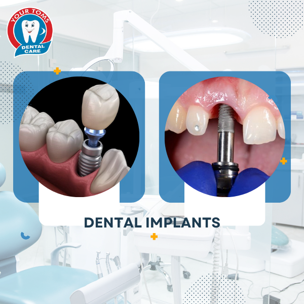 DENTAL IMPLANTS