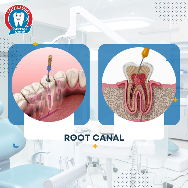ROOT CANAL