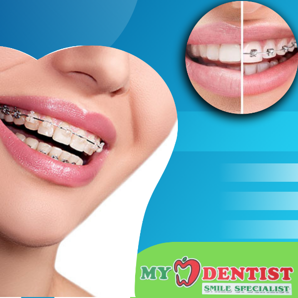 Clear Aligners