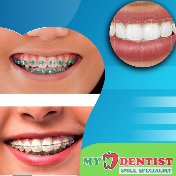 Orthodontic treatment- Steel and Ceramic braces