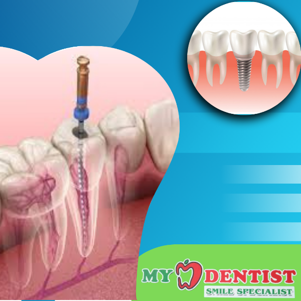 Root canal treatment