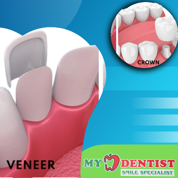 Veneers