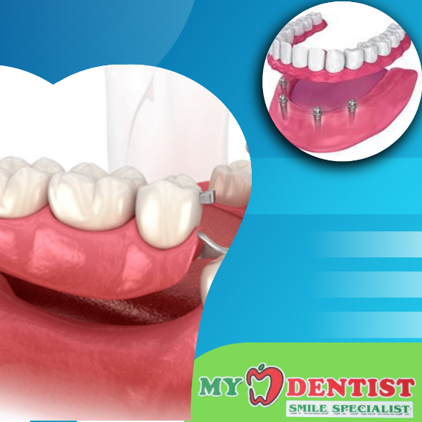 Partials Dentures and complete Dentures
