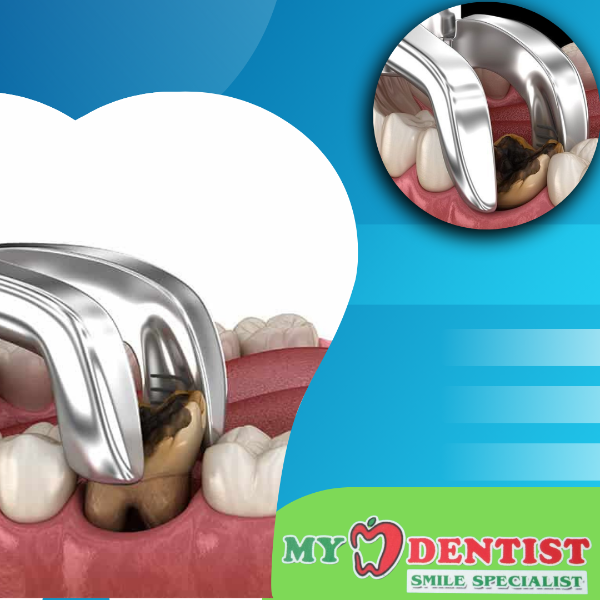 Dental Extractions