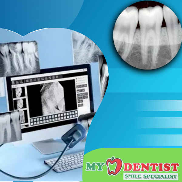 RVG  X rays