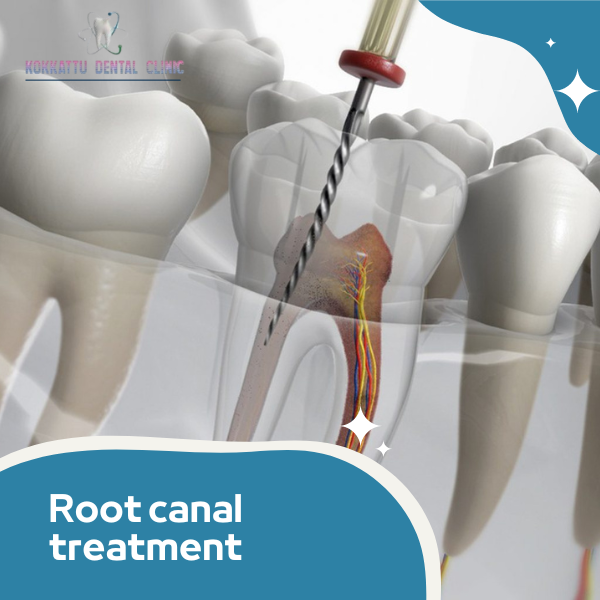 Root canal Treatment