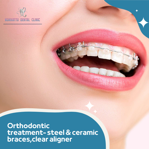 Orthodontic treatment- steel & Ceramic braces,clear aligner