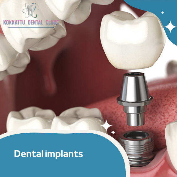 Dental implants