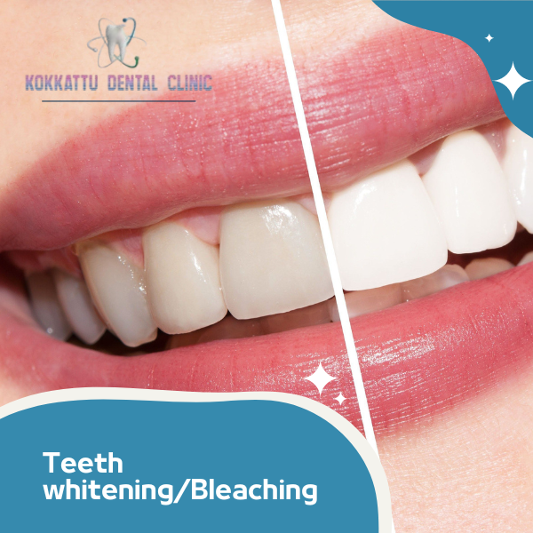 Teeth whitening/Bleaching