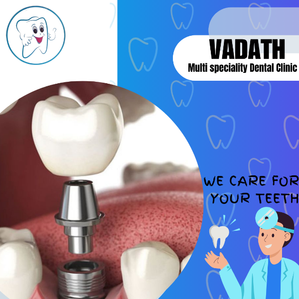 Dental implants