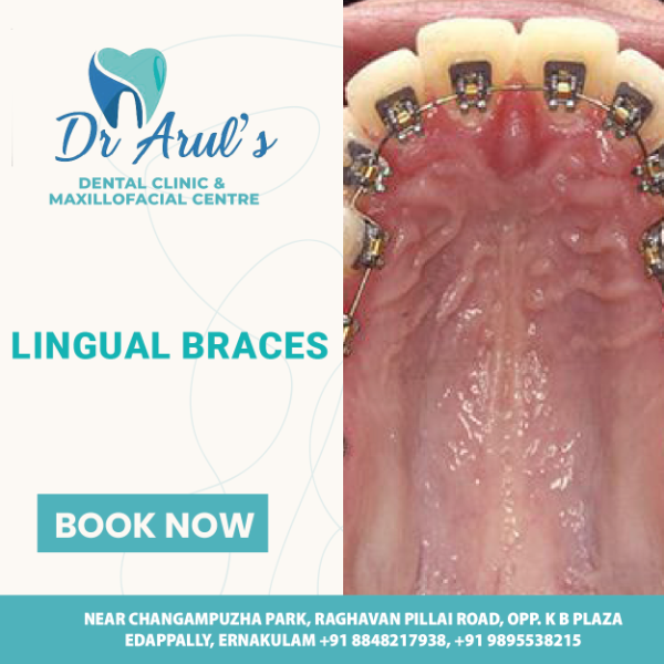 Lingual Braces