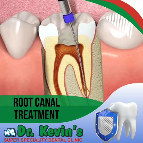 Root canal Treatment