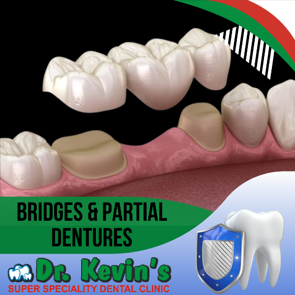 Bridges and Partial Dentures