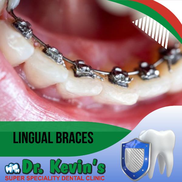 Lingual Braces