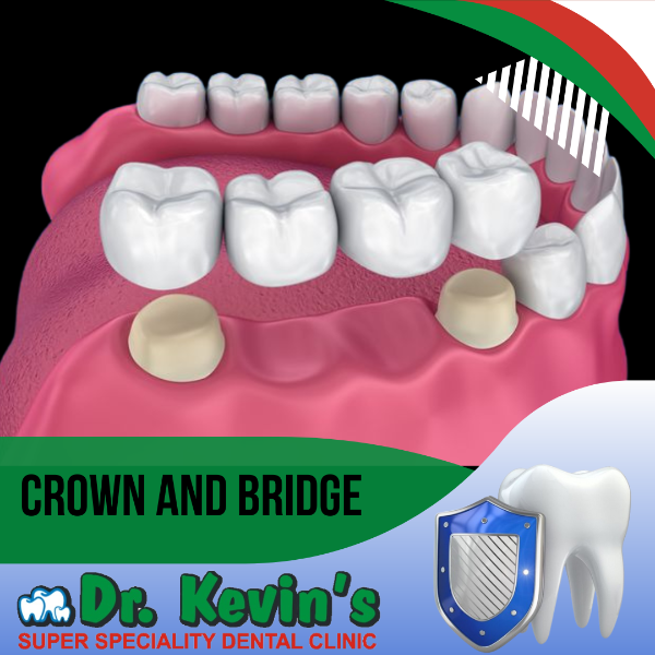 Crown and Bridge