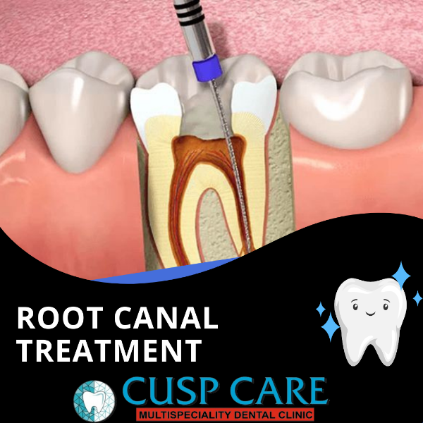 Root canal treatment