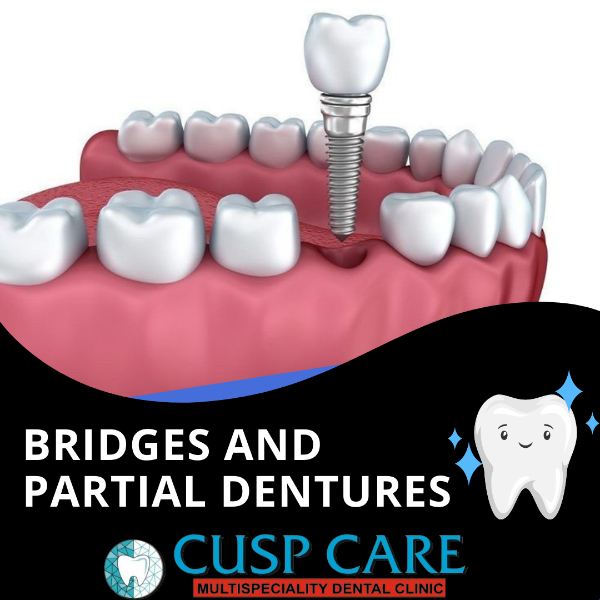 Bridges and Partial Dentures