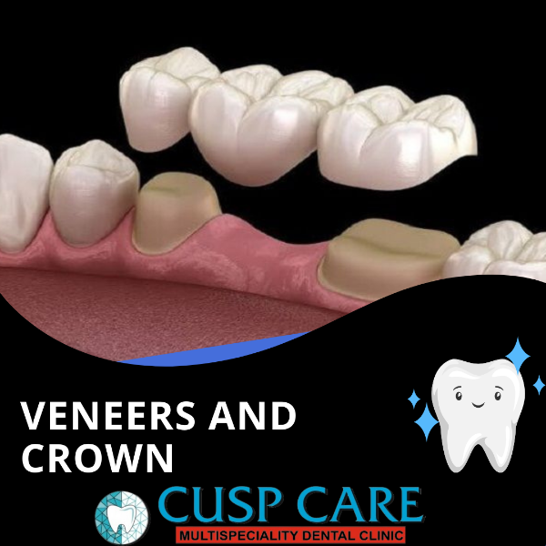 Veneers and Crown