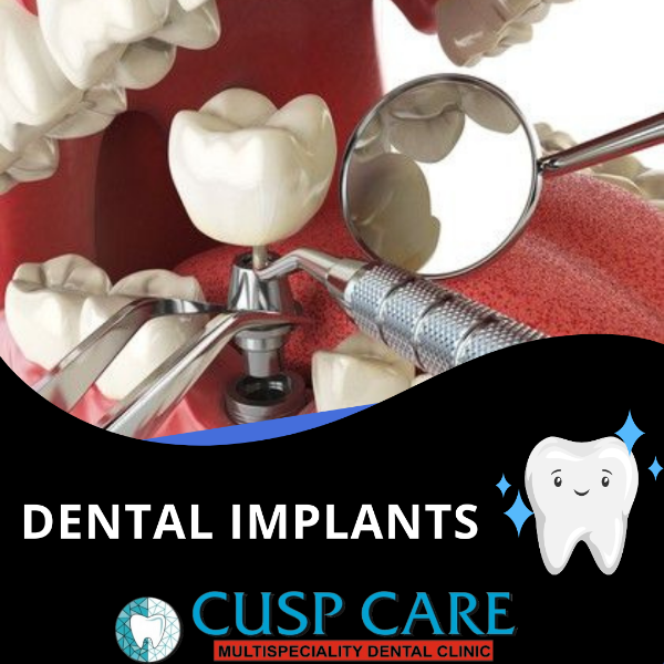 Dental implants