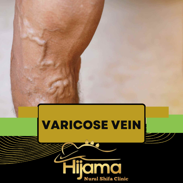 Varicose veins Treatment
