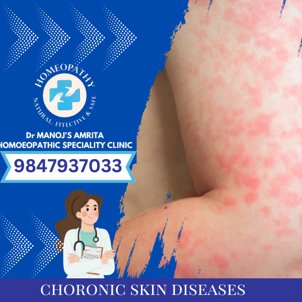 CHRONIC SKIN DISEASES
