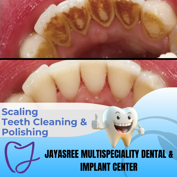 Scaling/ Teeth Cleaning & Polishing