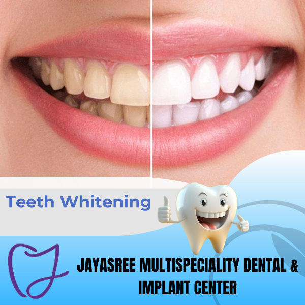 Teeth Whitening