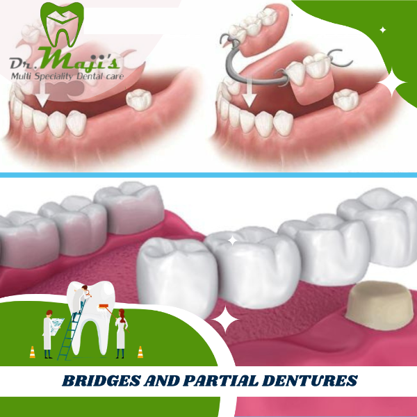 BRIDGES AND PARTIAL DENTURES