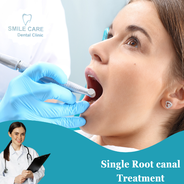 Single Rootcanal Treatment