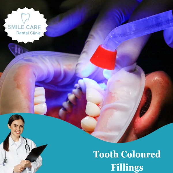 Tooth Coloured Filling