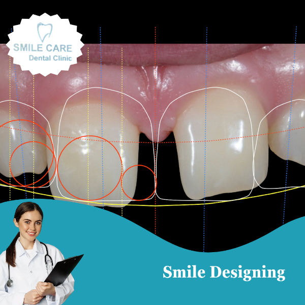 Smile Designing