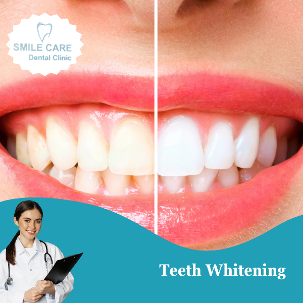 Teeth Whitening