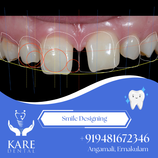 Smile Designing