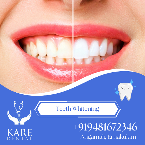 Teeth Whitening